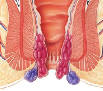 Hemoroid Hastalnda Devrim