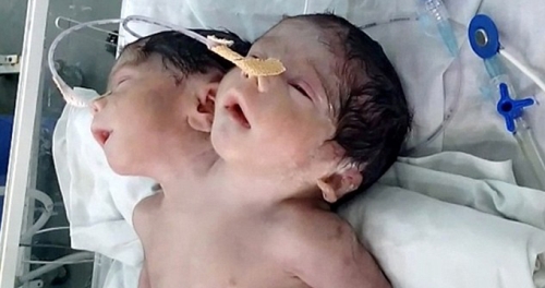 �ki Ba�l� Bebek, Do�umundan 32 Saat Sonra �ld�
